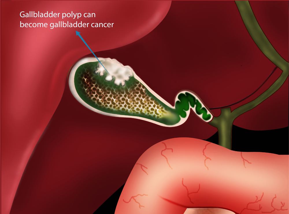 gallbladder polyps