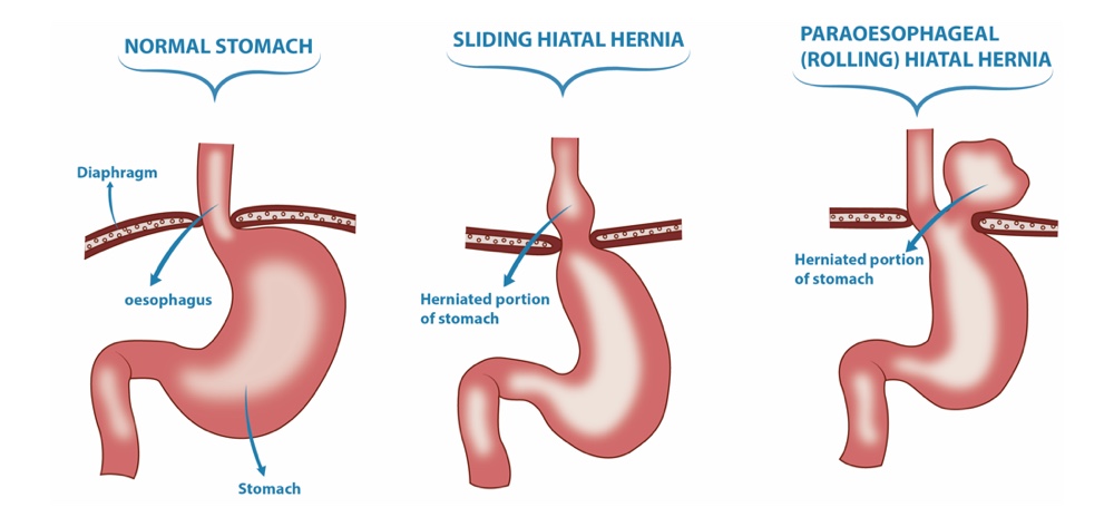 what is hiatal hernia