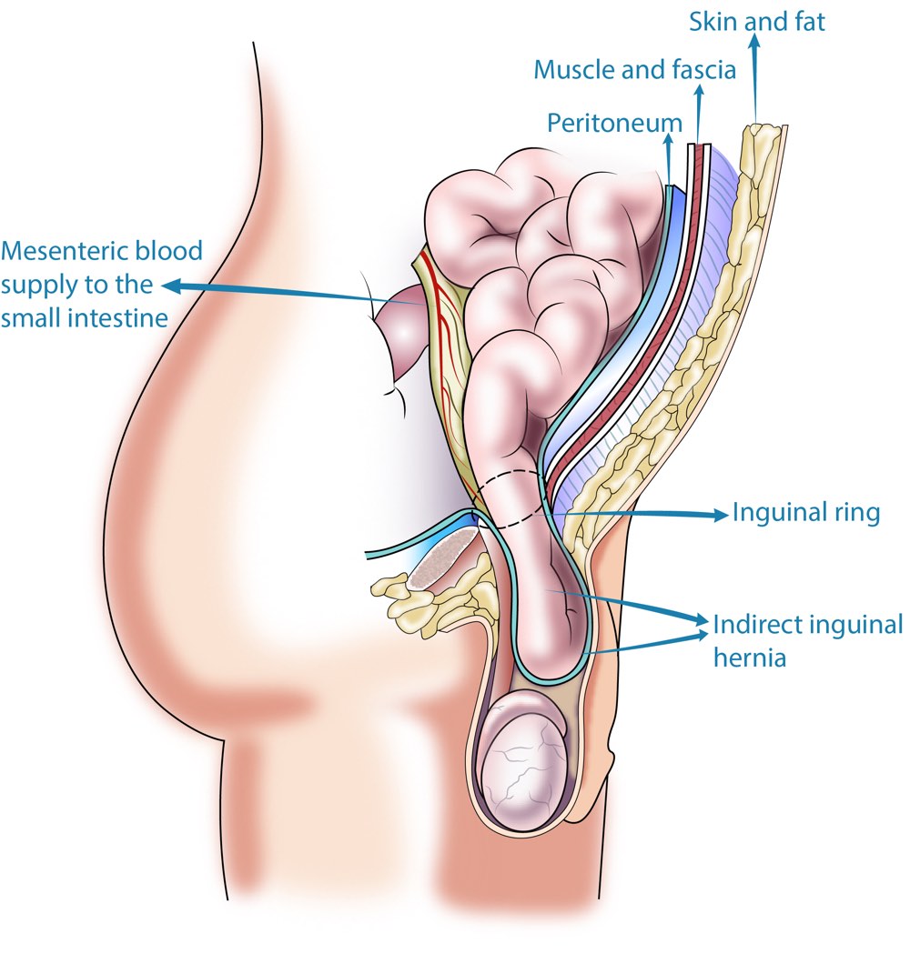 Inguinal Hernia - Types of hernia - Treatment / Hernia Surgery In Perth