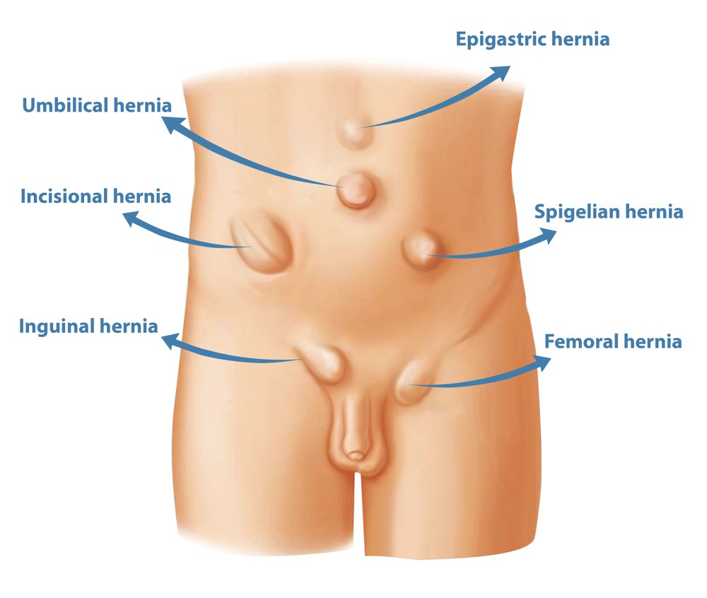 Diagnosis & Treatment of Umbilical Hernia